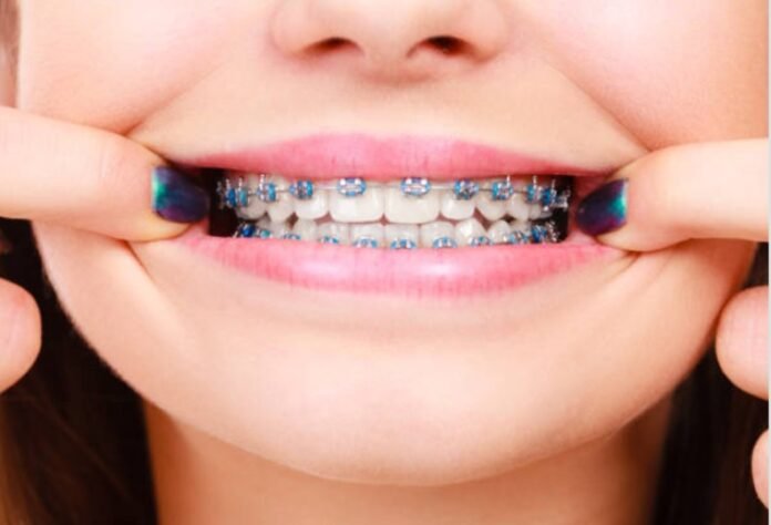 The Different Types of Teeth Braces and Which One is Right for You