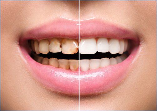 Restoring Damaged Teeth A Comprehensive Guide for a Healthy Smile