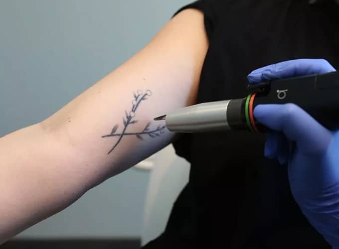  Safe and Effective Tattoo Removal in Alpharetta