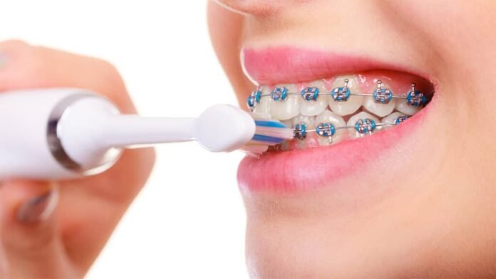 Braces in Thornton: A Month-By-Month Care Schedule
